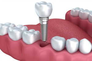 protesi dentale fissa
