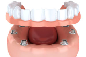 protesi dentale mobile