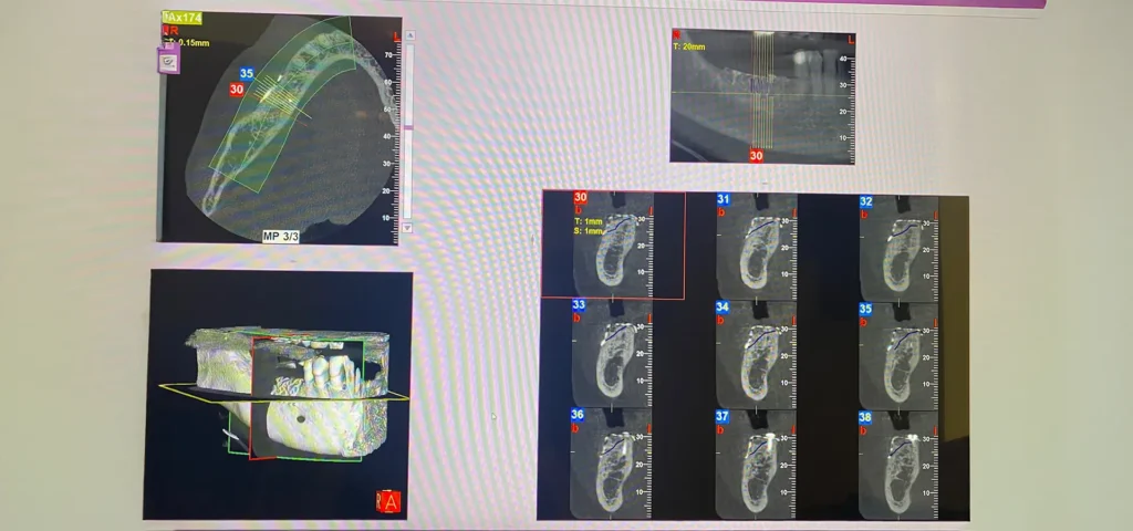 Implantologia Guidata